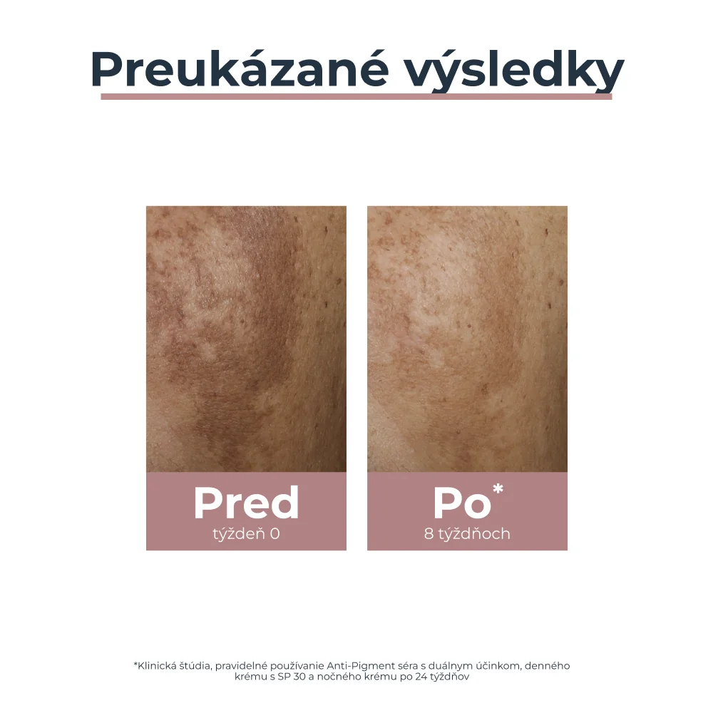 Eucerin ANTI-PIGMENT Denný krém SPF 30 1×50 ml, hyperpigmentácia pleti