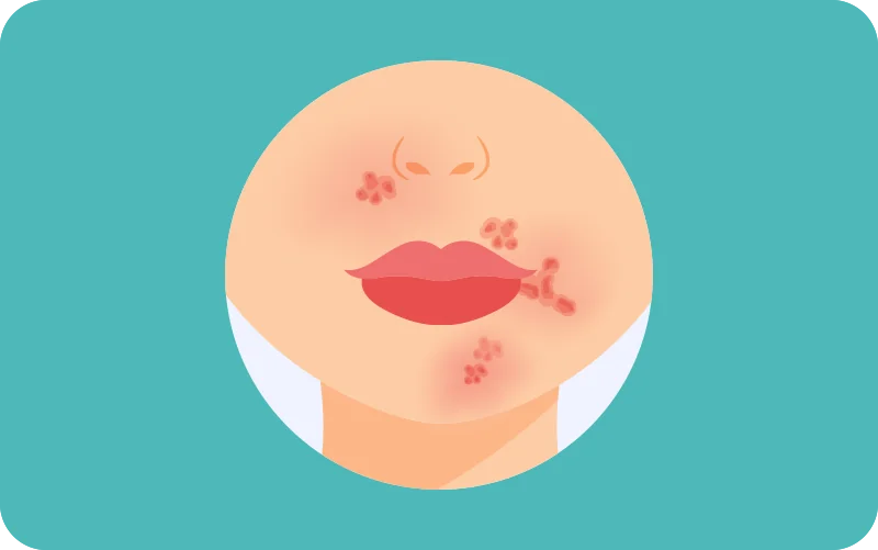 impetigo 