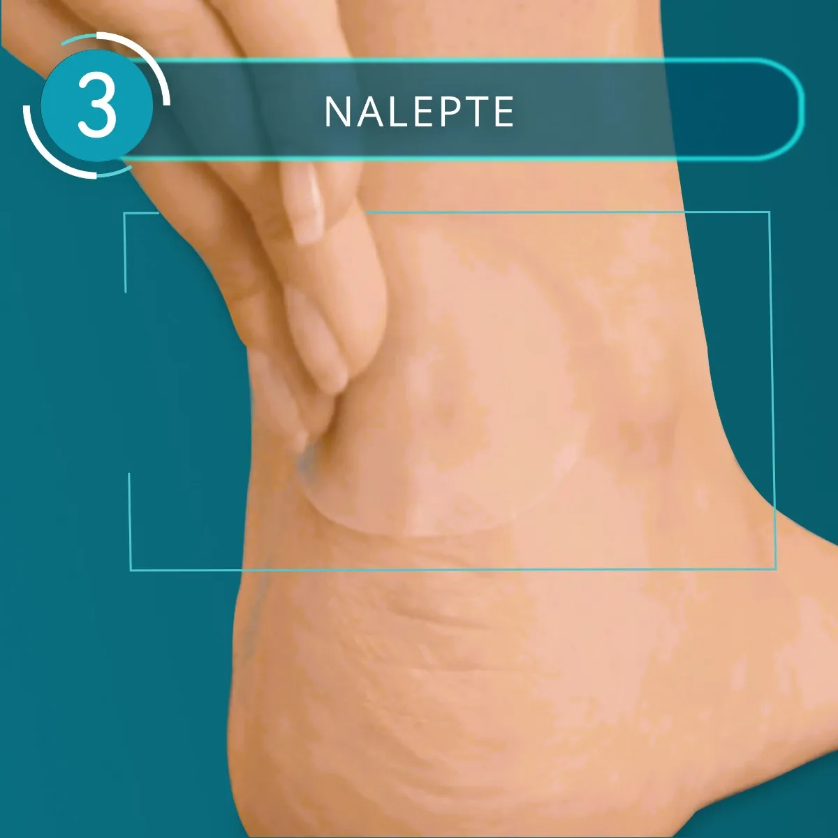 Compeed NÁPLASŤ na pľuzgiere MIX 1×5 ks, náplaste MIX