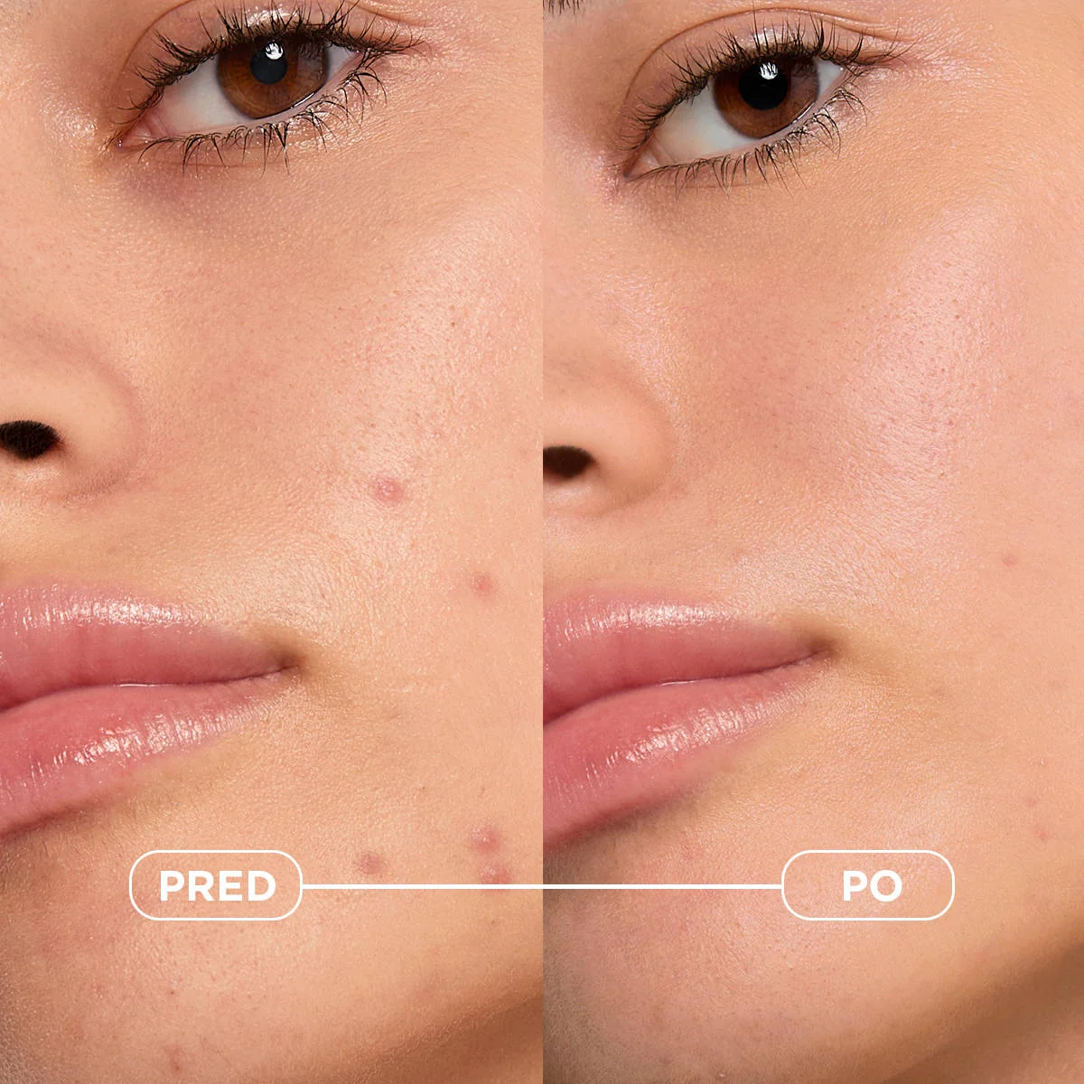 BIODERMA Sébium Kerato+ gél-krém na akné s vysokou toleranciou 1×30 ml, pleťový krém