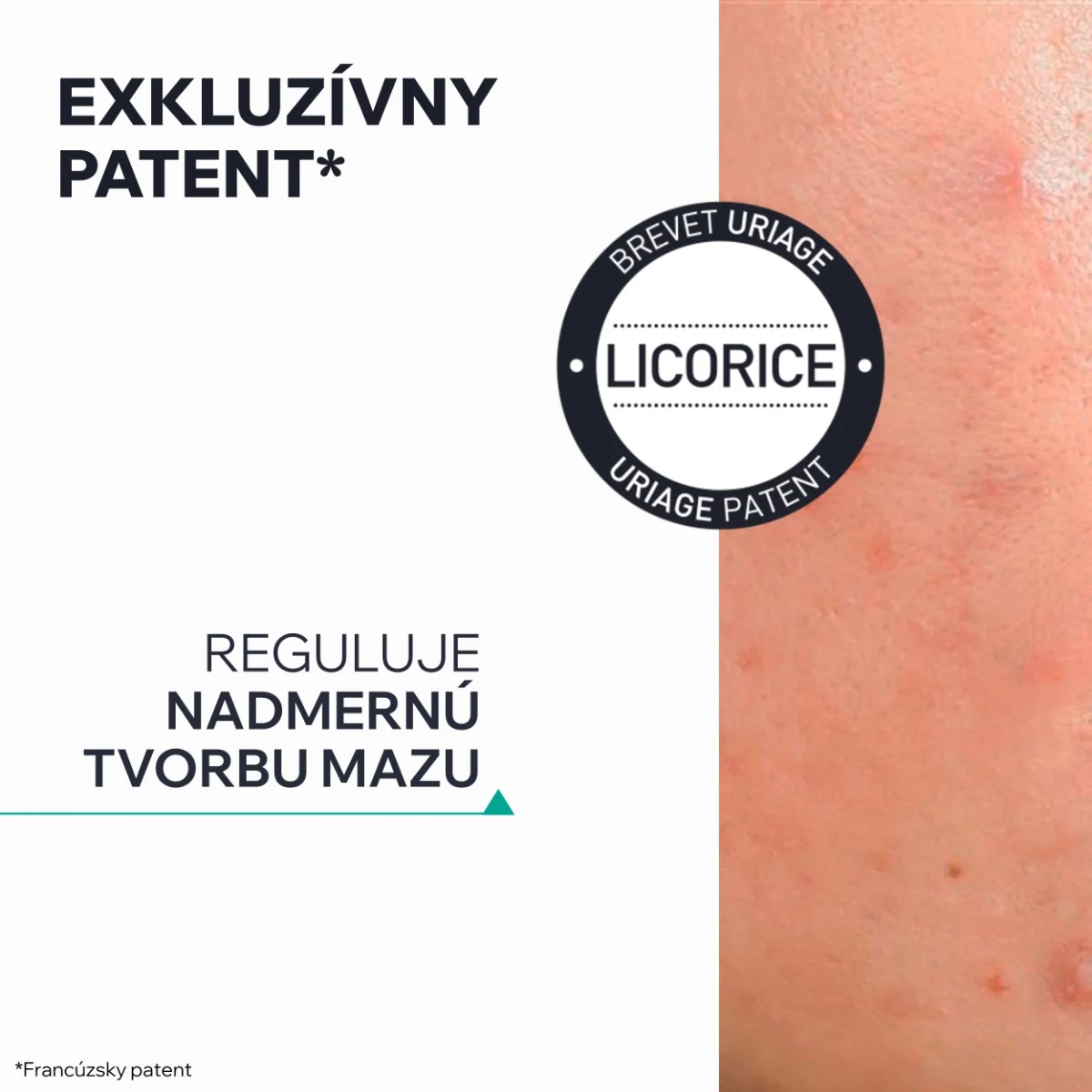 URIAGE HYSEAC SOS Drying Gel 1×15 ml, vysušujúci gél na mastnú pleť s nedokonalosťami