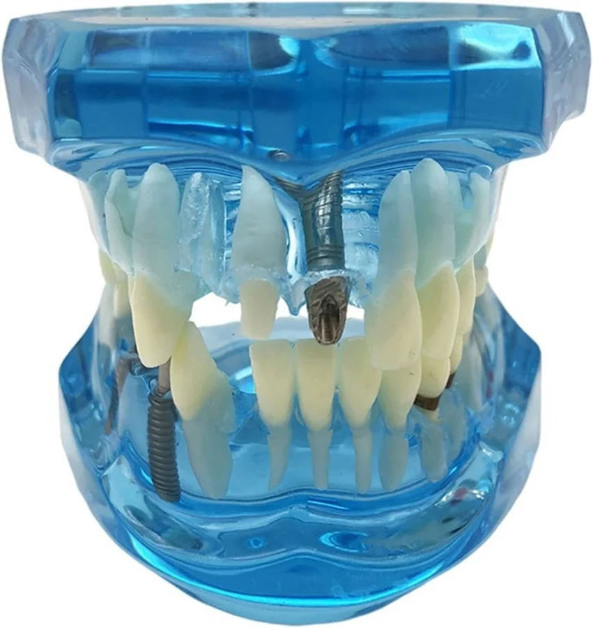 Zubný model čeľuste zuby zubné implantáty