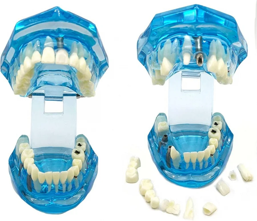 Zubný model čeľuste zuby zubné implantáty