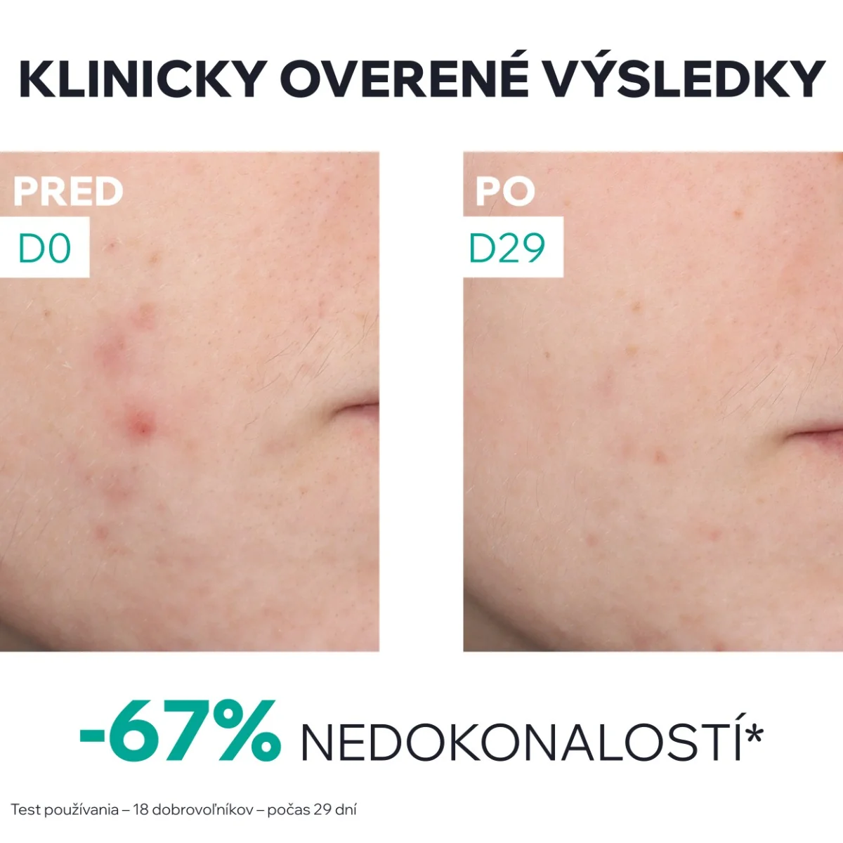URIAGE HYSÉAC New Skin Serum 1×30 ml, sérum na mastnú pleť s nedokonalosťami