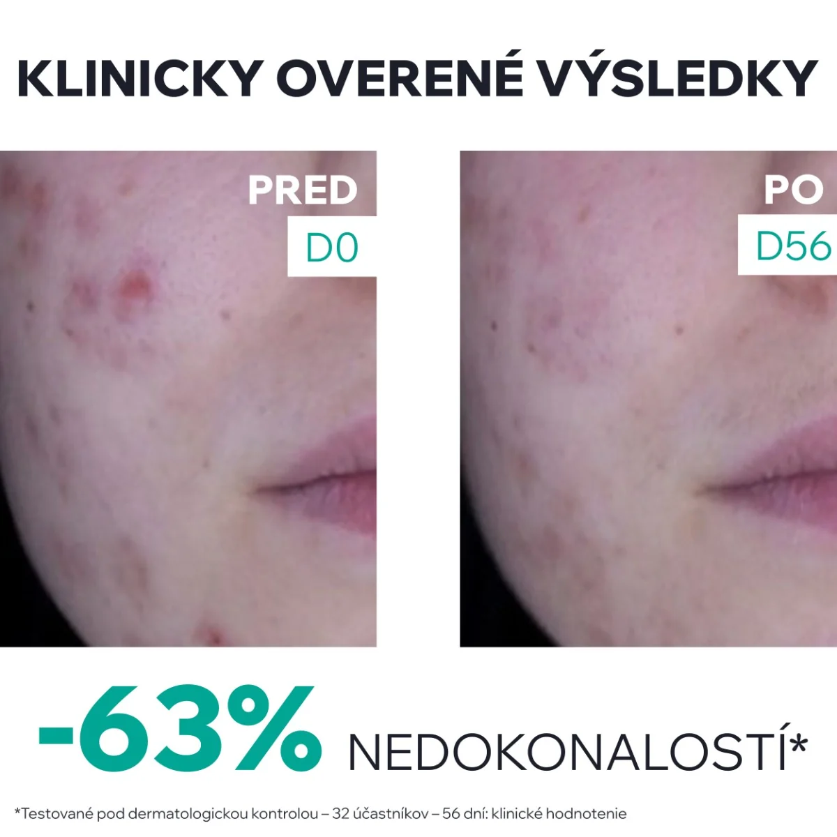 URIAGE HYSEAC 3-Regul+ 1×40 ml, denný krém pre pleť s nedokonalosťami