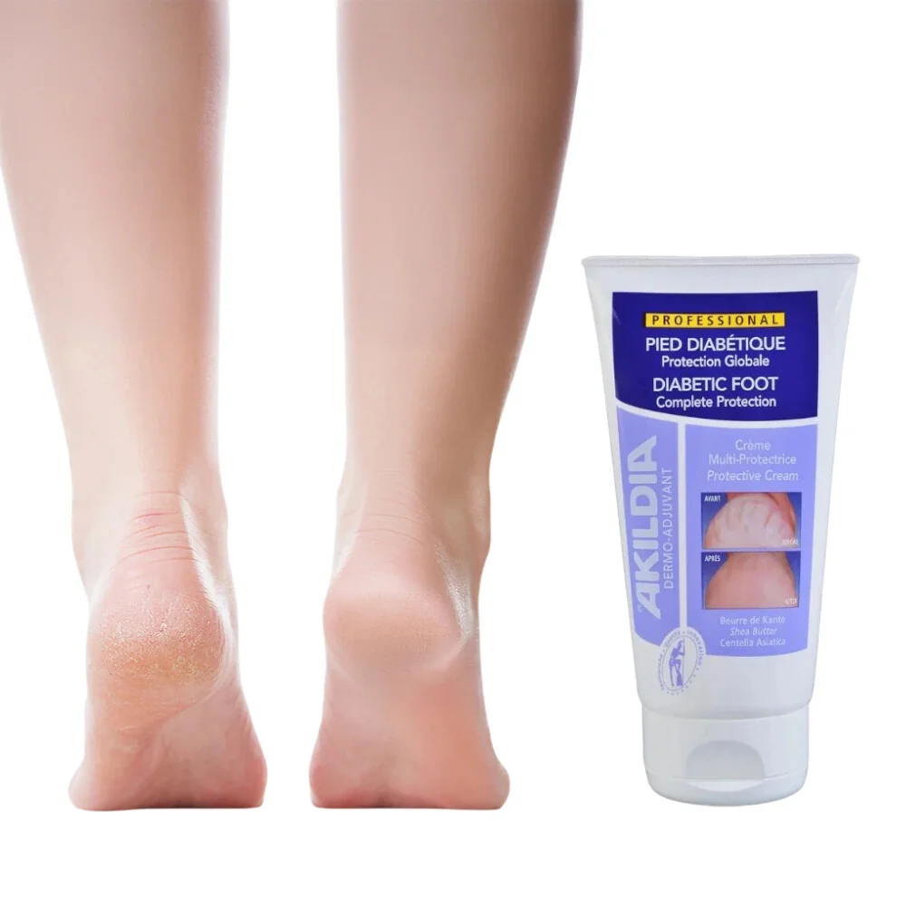 Ochranný krém na nohy pre diabetikov, Akildia Pro - 150 ml