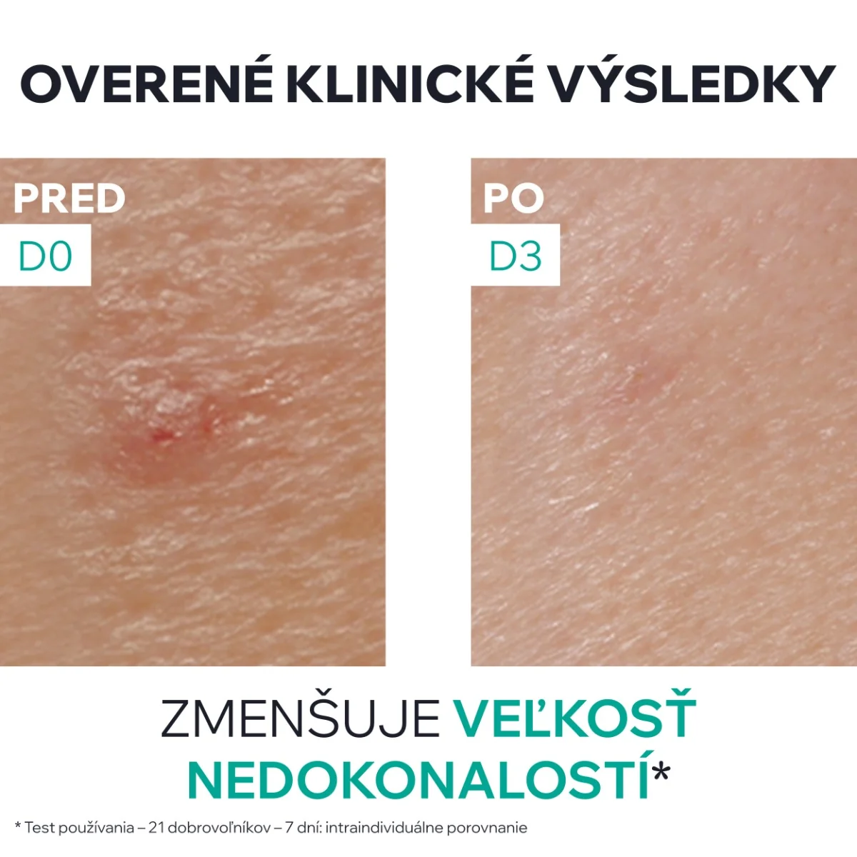 URIAGE HYSEAC SOS Paste 1x15 g, lokálna starostlivosť pre mastnú pleť s nedokonalosťami