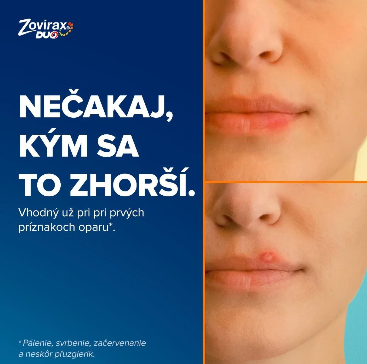 Zovirax Duo 2 g 1x2g, liečba oparov na pere s účinnou látkou aciklovirom a hydrocortisonom