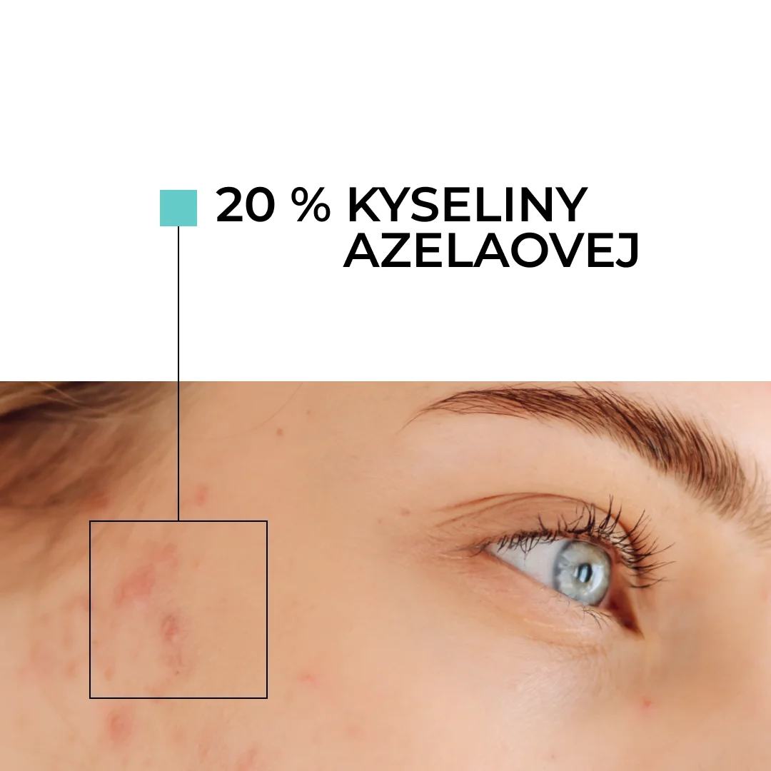 Skinexpert by Dr. Max® ACNEPRO Intensive Face Cream 1×30 g, krém na tvár proti nedokonalostiam pleti