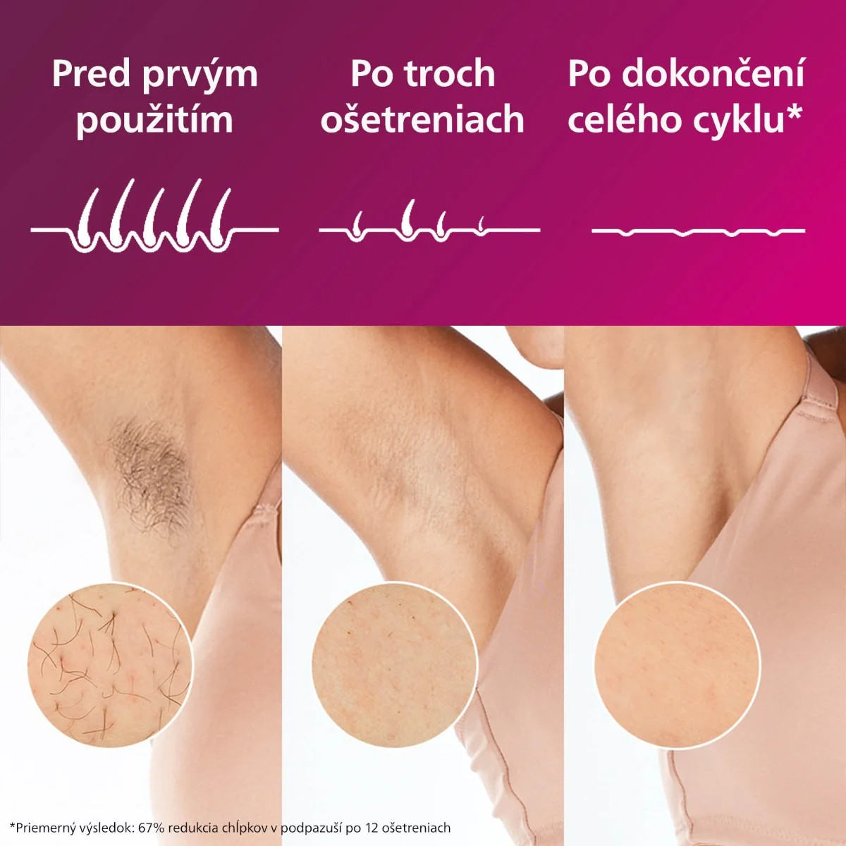 Philips Lumea IPL 8000 BRI940/00 SenseIQ 1x1 ks, IPL epilátor