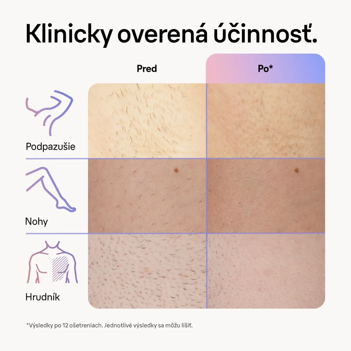 Braun Smart IPL Skin i expert, Domáca Epilácia, Puzdro, 2 Hlavice, PL7147 1×1 ks, epilátor