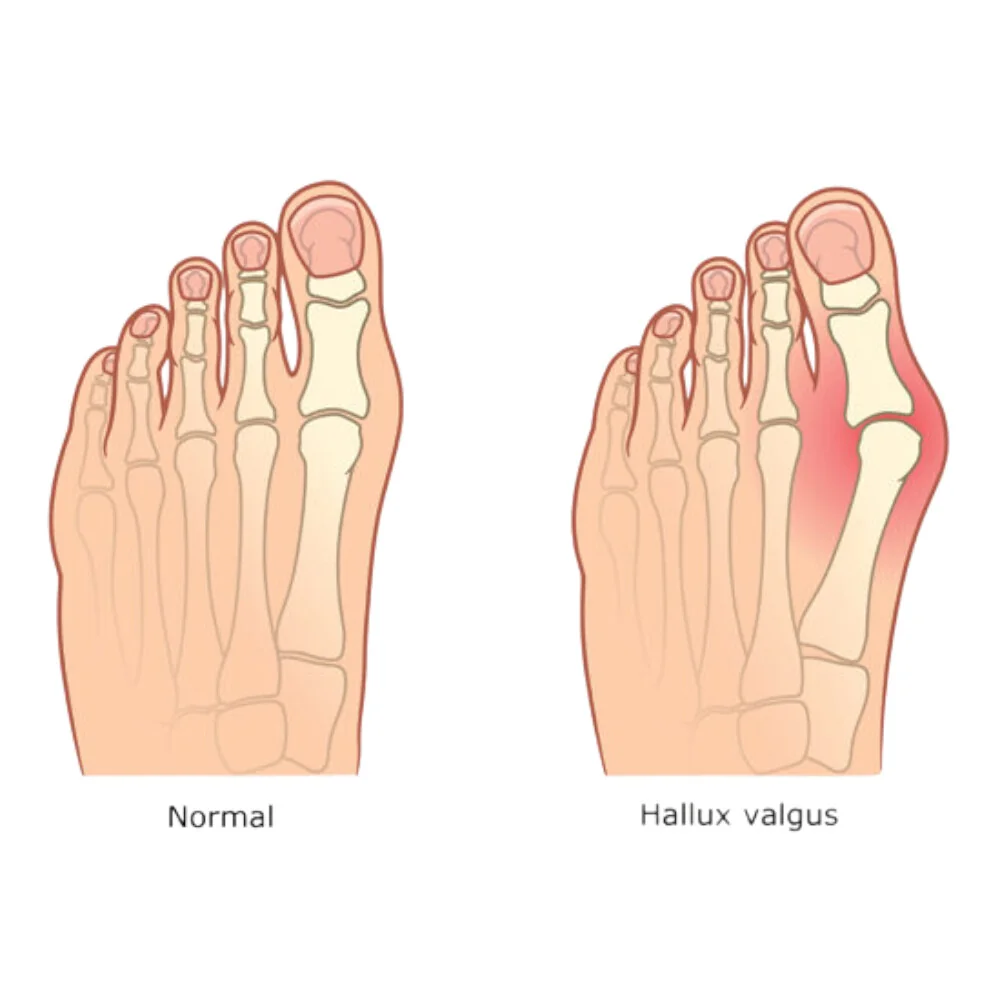 Elastická bandáž na Hallux Valgus s klinom - 1 pár