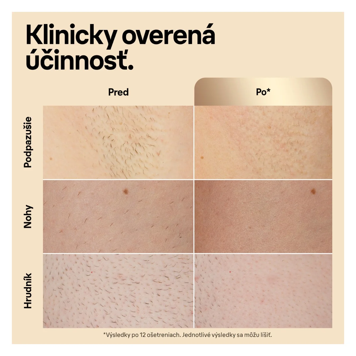 Braun IPL Silk·expert Pro 5, Odstraňovanie Chĺpkov v Pohodlí Domova, S Puzdro, 2 Hlavice, PL5152 1×1 ks, epilátor