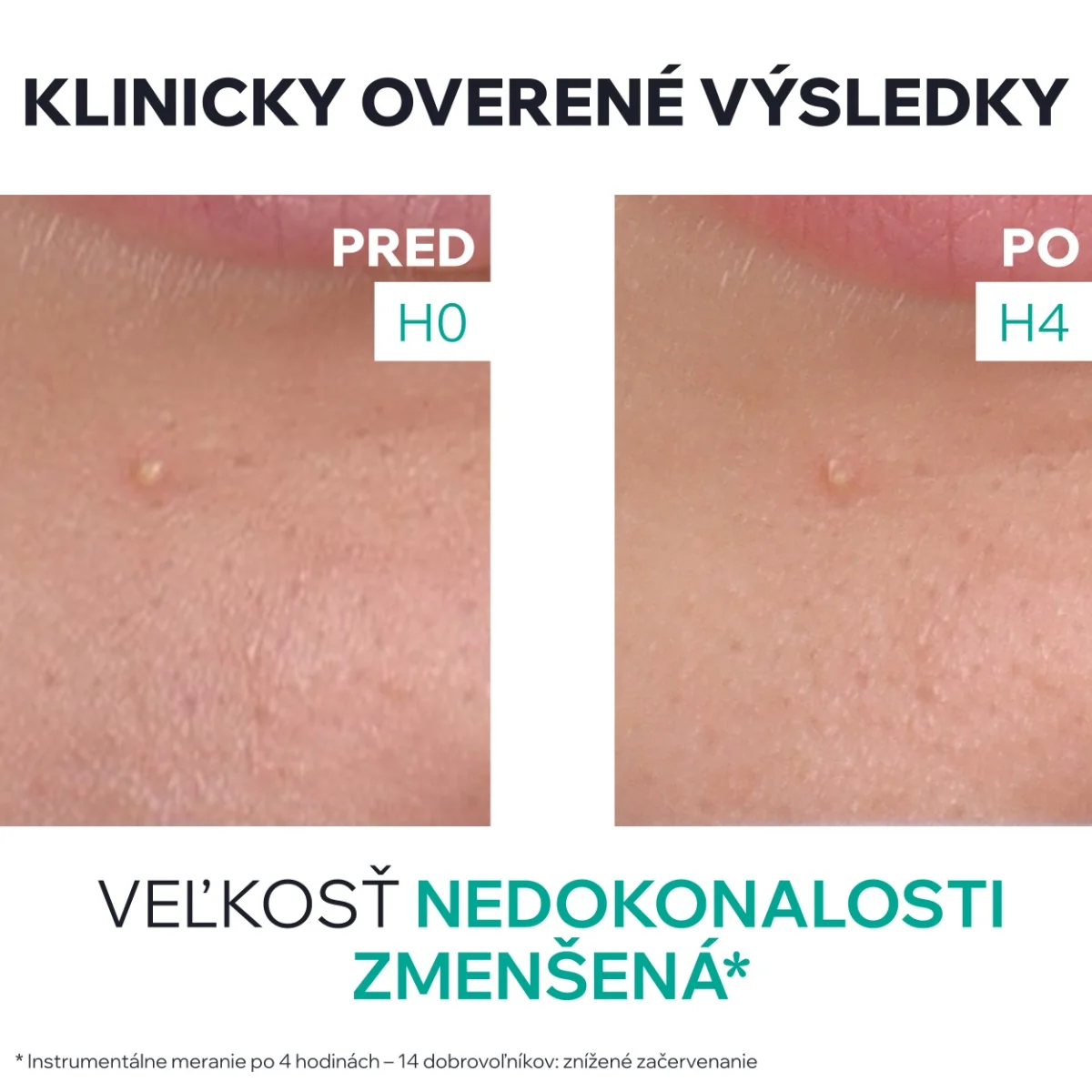 URIAGE HYSEAC SOS Drying Gel 1×15 ml, vysušujúci gél na mastnú pleť s nedokonalosťami